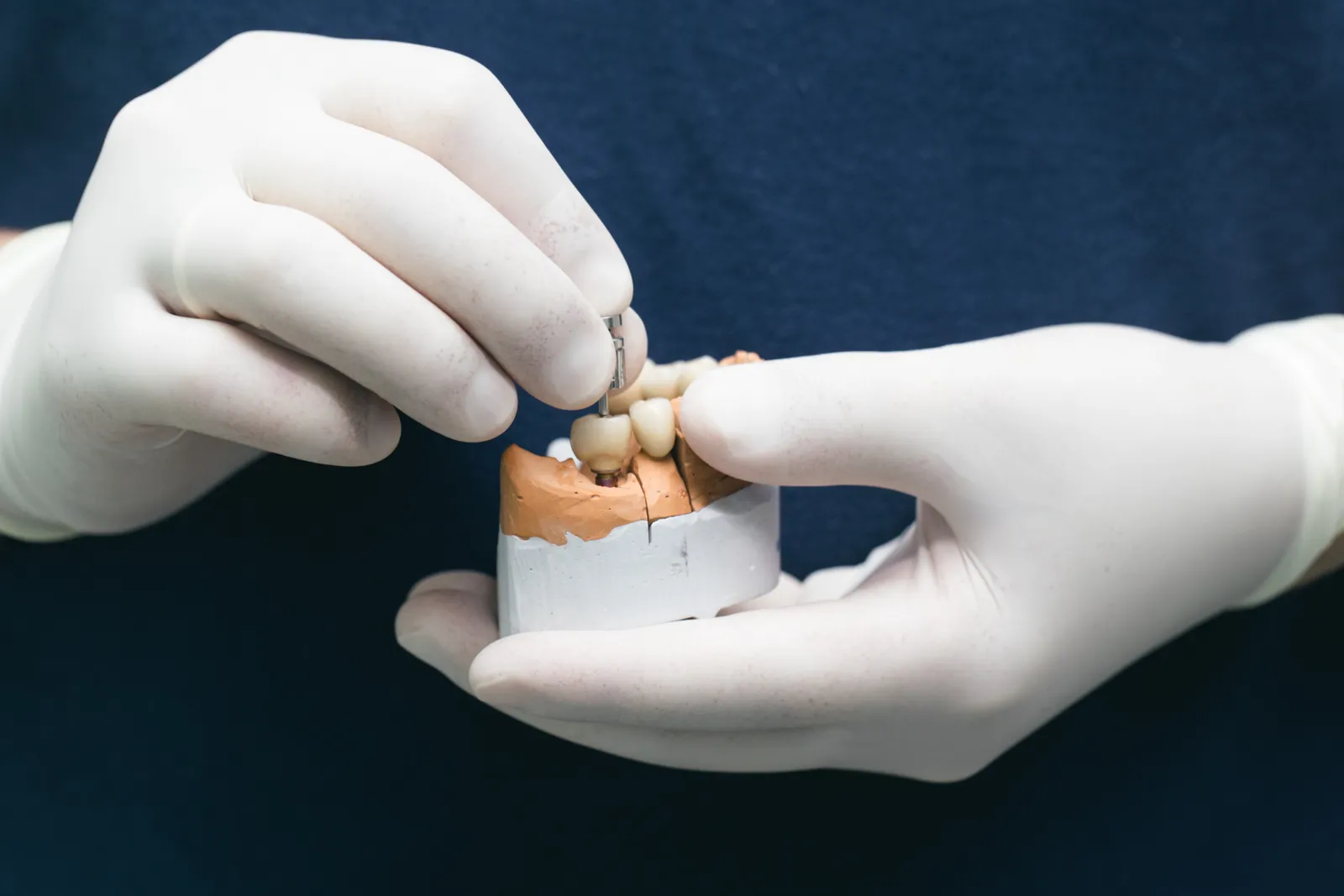 Implante de zirconio o titanio: cuál es mejor y cómo elegir en Ereván