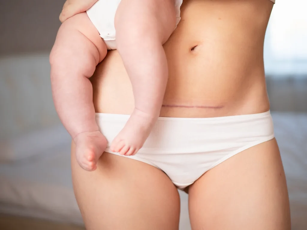 Mommy Makeover